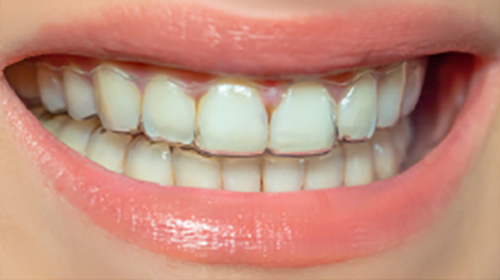 歯並び・機能性の追求