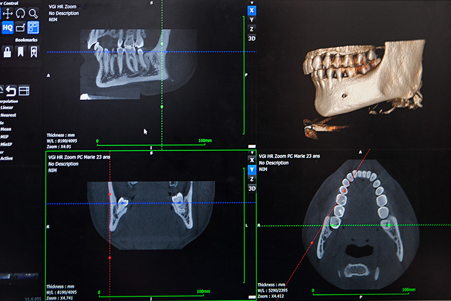 歯科用CTによる診査診断